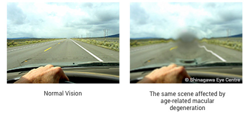Vision difference between normal and Macular Degeneration - Age Related