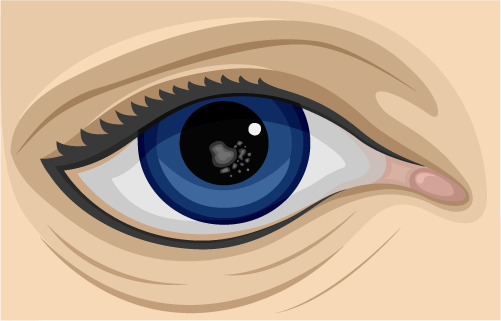 Posterior-Subcapsular-Cataracts