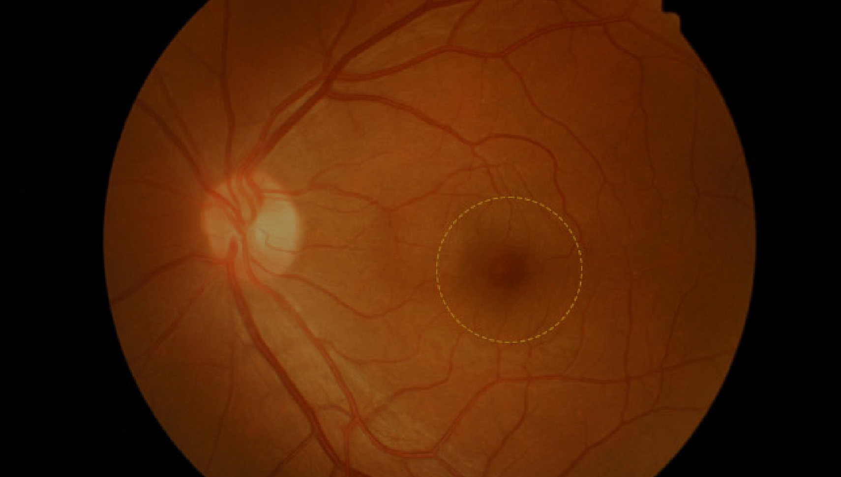 What Is a Macular Hole and How to Treat It?